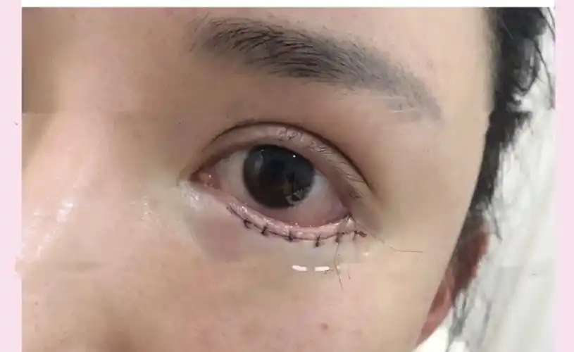 眼睛下至前后图片