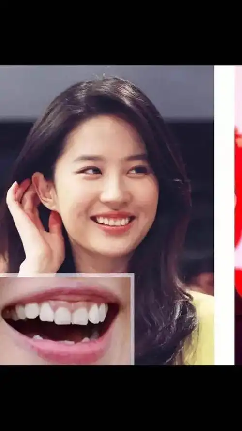 刘亦菲牙上的黑线是怎么了?