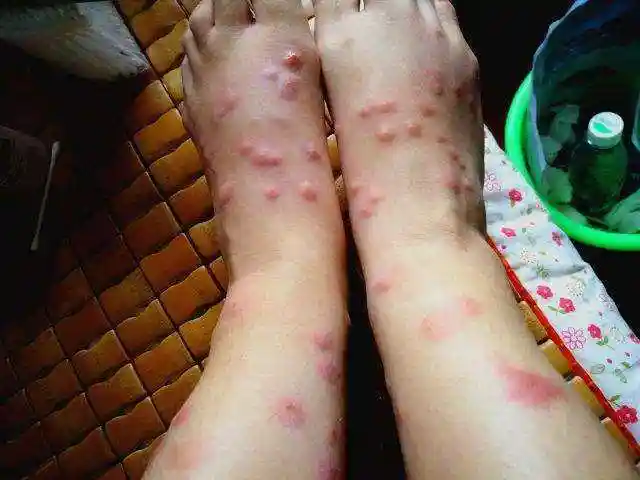 被跳蚤咬了是什么样的?