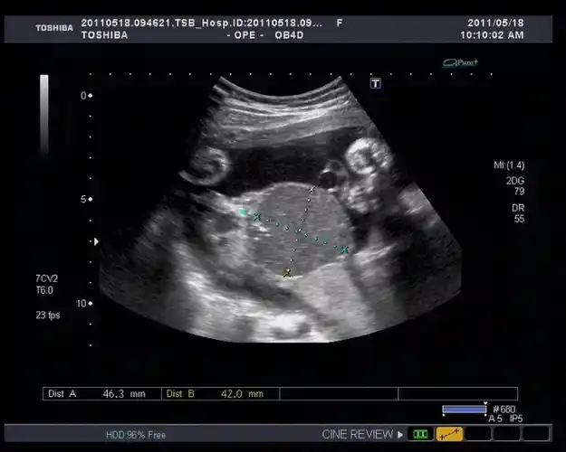 胎盘血管瘤与血池