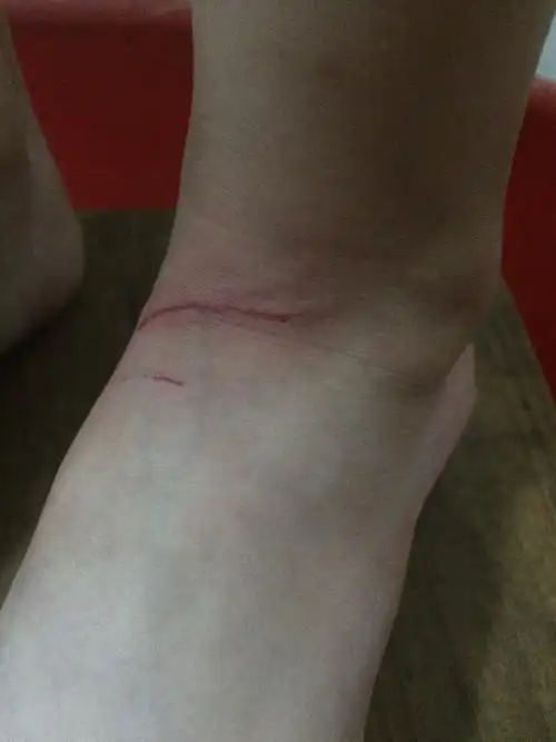 请问一下大家我妹妹4岁 刚不小给猫咪的爪子刮到脚了 还出血了 要不要