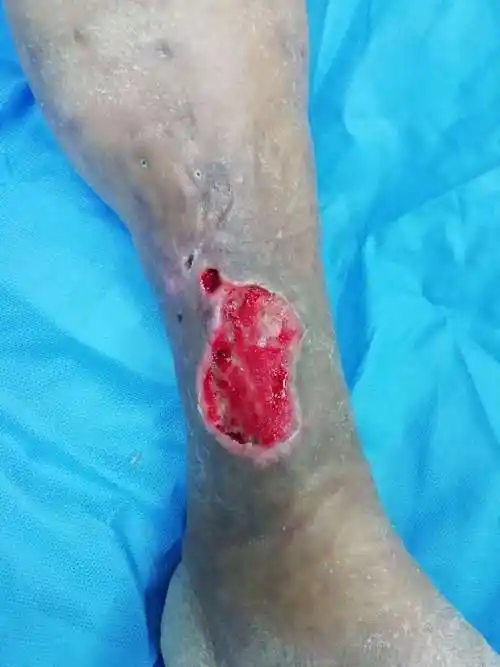 左小腿术后伤口不愈合