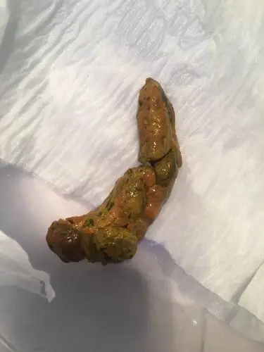 因为做胃镜太难受.所以问问这大便属于黑大便吗.