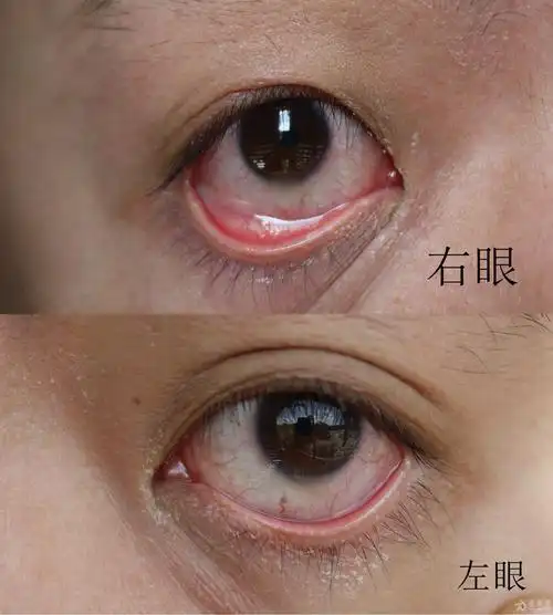 结膜炎还是其他六年反复不愈恳请各位老师帮助