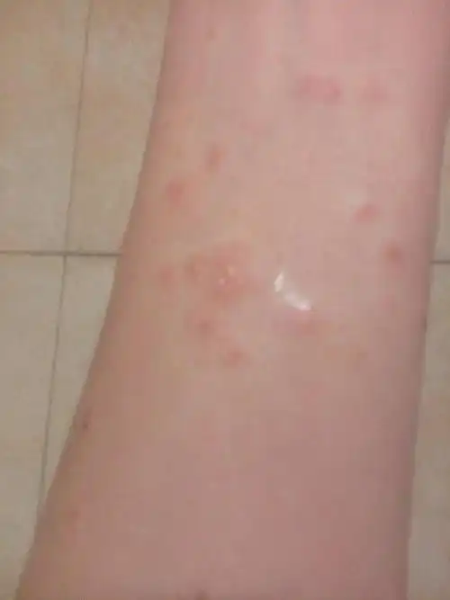 手臂长了痘痘,然后挤出水了,现在越长越大,手臂有一片,这是什么东西