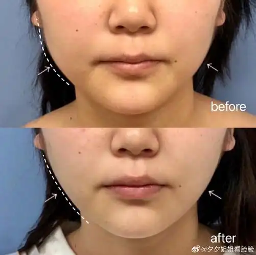 面部3个月,前后对比