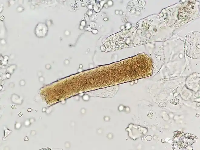 【多图对比】血液管型与血红蛋白管型鉴别|红细胞|镜检|沉渣_网易订阅