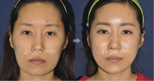 长脸变短有自然方法吗?韩国下巴缩短手术图解分享!