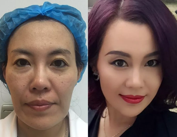 武汉艺星面部提升前后对比