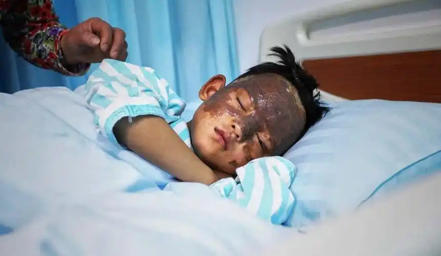 出自三胞胎贫困家庭,9岁意外烧伤娃,不知道"排骨"是啥__凤凰网