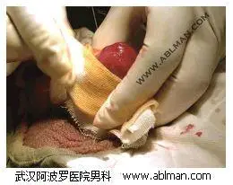 老年人包茎包皮环切手术过程直播(图)
