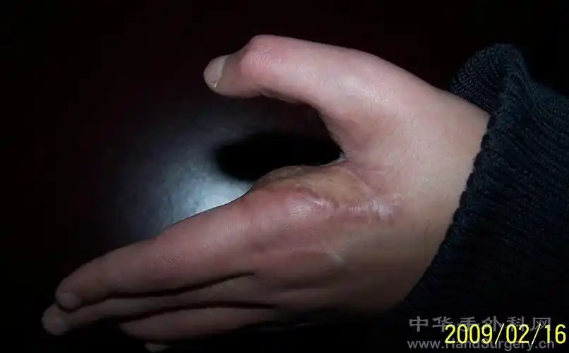 手掌疤痕一年