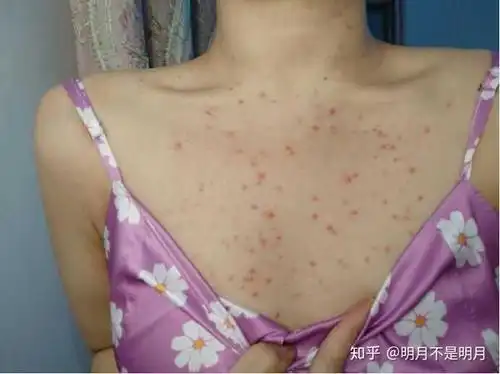 关注问题 67 写回答 青春痘 皮肤病 毛囊炎 痤疮 背肌 后背上长痘