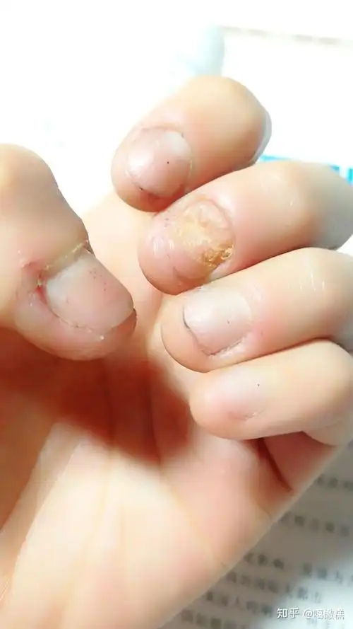 咬指甲怎么戒除?