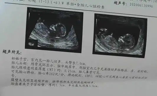 3mm的话男女是分不清的. 只能说明胎儿通过了这次的nt检查.