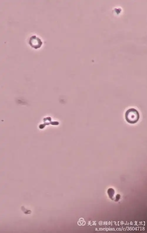 非新鲜尿中的棘形红细胞