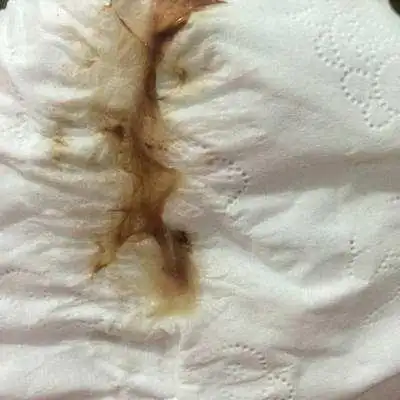 孕妈们需要先了解褐色分泌物的原因,不然胎儿可就遭殃了怀孕初期这个