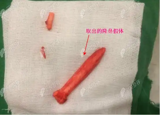 终于取出17年的鼻子硅胶假体取出后马上重新做还挺不错