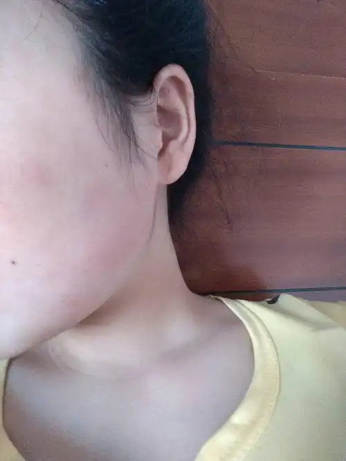 脸部过敏严重蜕皮以后发现皮肤红红的亮亮的,还很痒,该怎么办