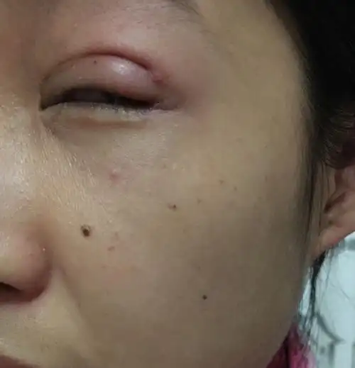 埋线双眼皮20天眼尾长个包,有点疼,问大夫他说是感染,让把脓挤出来就