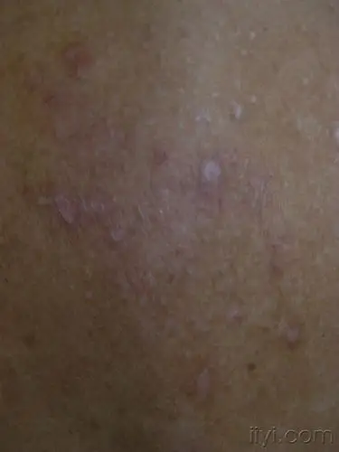 神经性皮炎?皮肤淀粉样变?