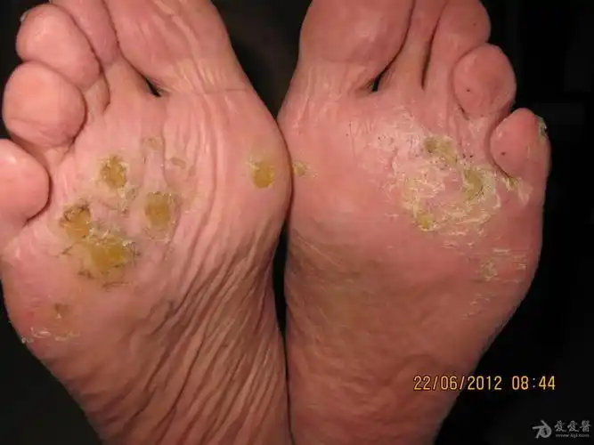 点状掌跖角化症1例