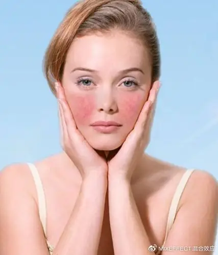 敏感肌肤换季过敏发红起小疙瘩有红血丝怎么办