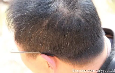 不同位置白发提示不同病