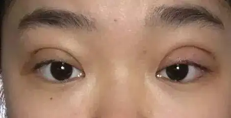 做双眼皮危害 ,五类人不宜做