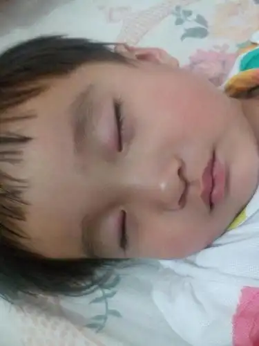 宝宝上眼皮红红的