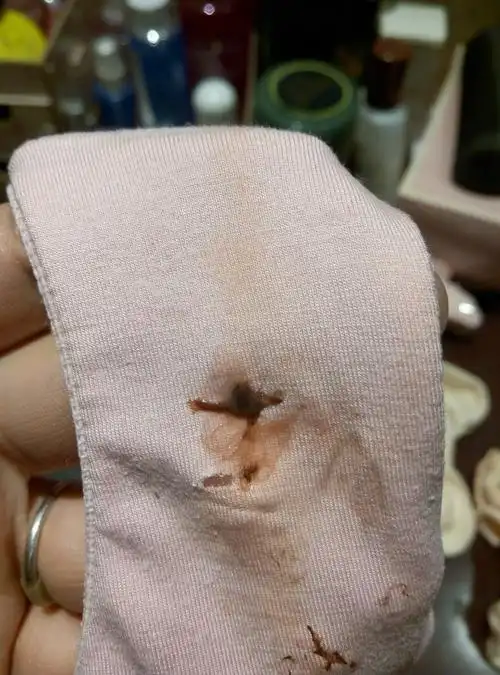 谁能告诉我这是排卵性出血还是炎症,还是宫颈