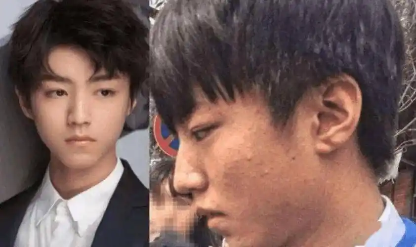 青春期的王俊凯脸上其实有很多的青春痘,在素颜卸妆以后他脸上的青春