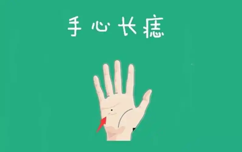 女人手掌上长痣图解(女人手掌上长痣图解图片)