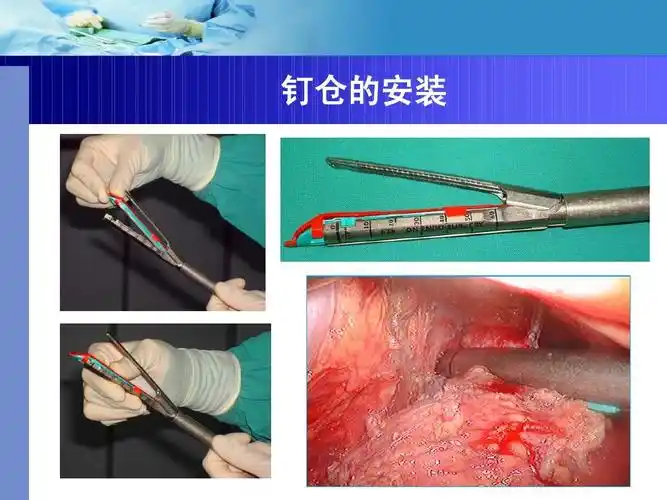 内镜下吻合器的准备ppt