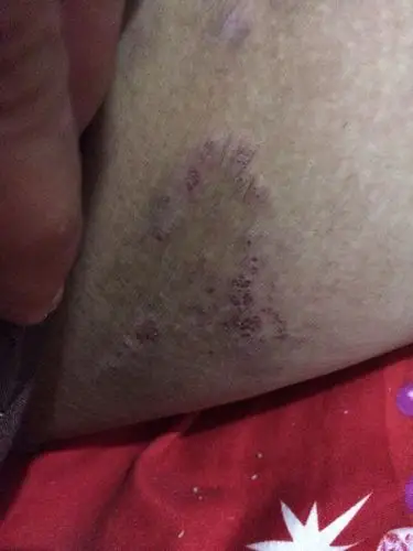 (找皮肤大夫)大腿内侧瘙痒,皮肤发黑,这是什么病?