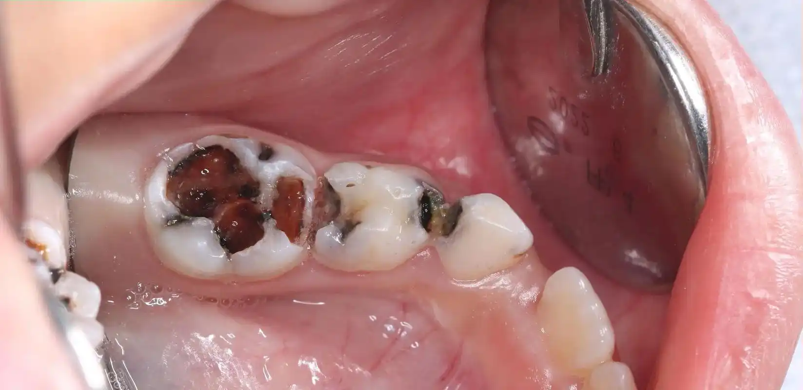 乳磨牙大面积龋坏缺损,充填材料反复脱落,继发龋形成,这个时候 - 抖音