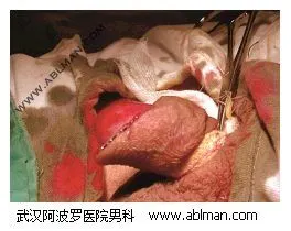 刚手术结束的包皮切割缘外观