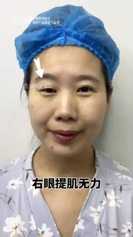 右眼提肌无力 上睑下垂