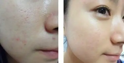 收缩毛孔有什么好方法吗?