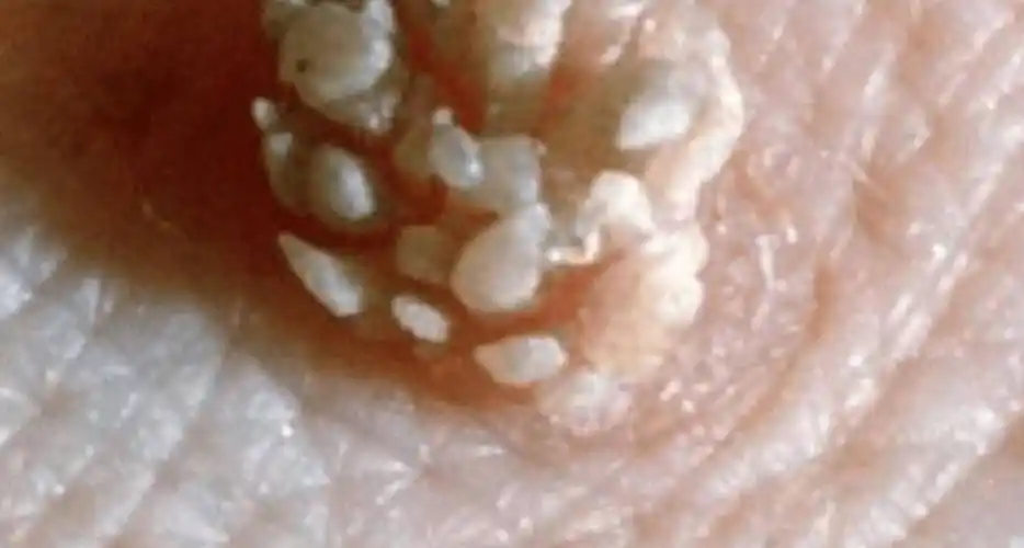 宫颈病,喉病,膀胱病,与它有关,医生:可预防_生殖器_消息_病毒