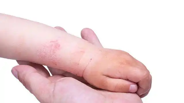 皮肤瘙痒长疙瘩别不在意这5种皮肤病在兴风作浪