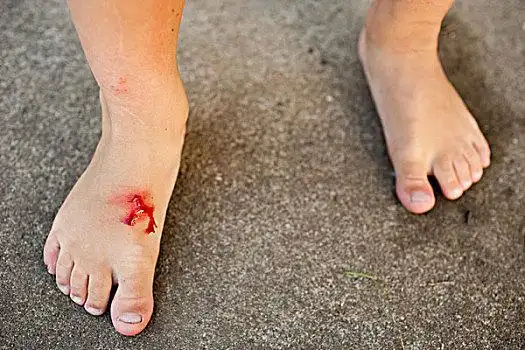 女孩,伤口,脚