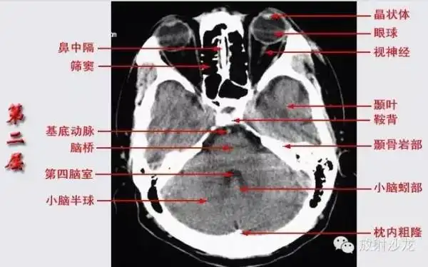 头颅ct断层解剖