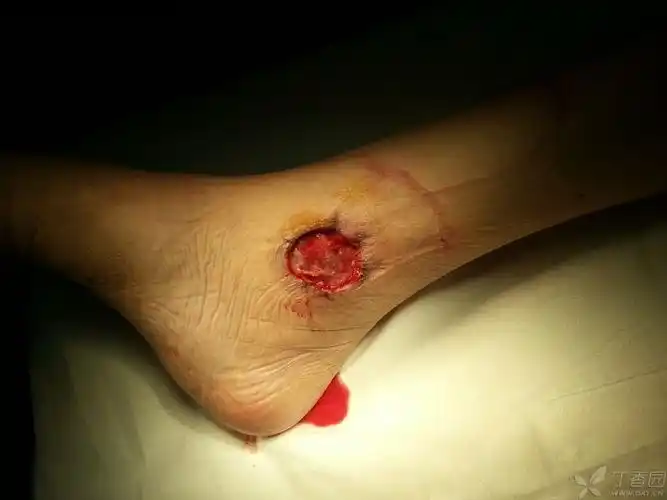 一例下肢皮肤坏死,头大啊