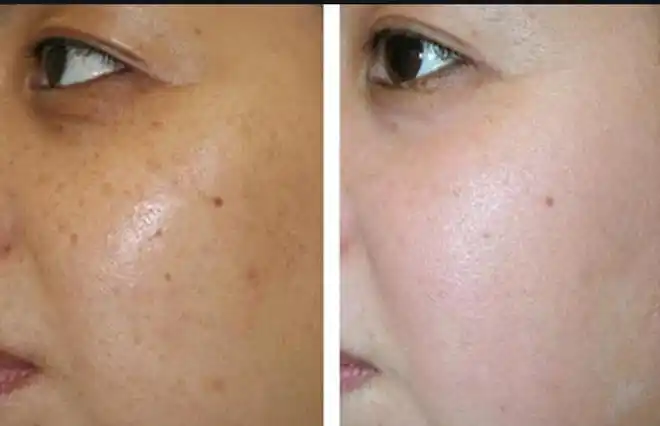 淡斑产品真的可以淡斑吗国家唯一认证的祛斑产品可以