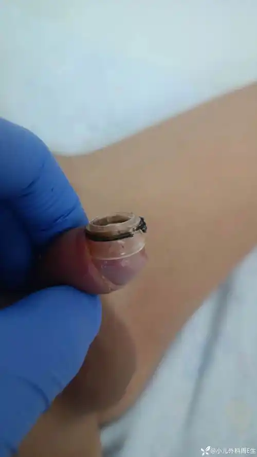 小儿包皮术后拆除环套