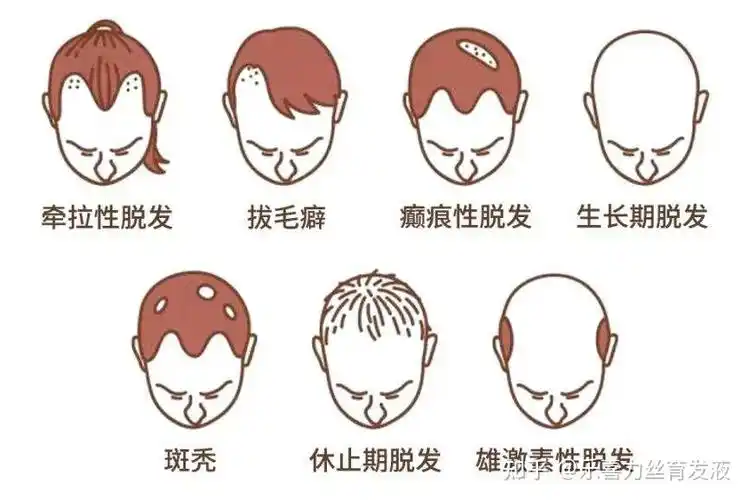 除了雄脱,我们常见的脱发类型有:脂溢性脱发,精神压力性脱发,产后脱发