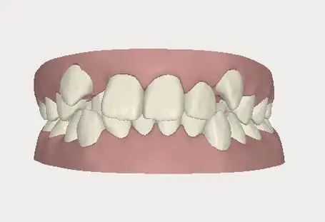 虎牙长得太丑了好想直接拔掉啊