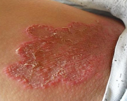 体股癣初期现象图片 (12)