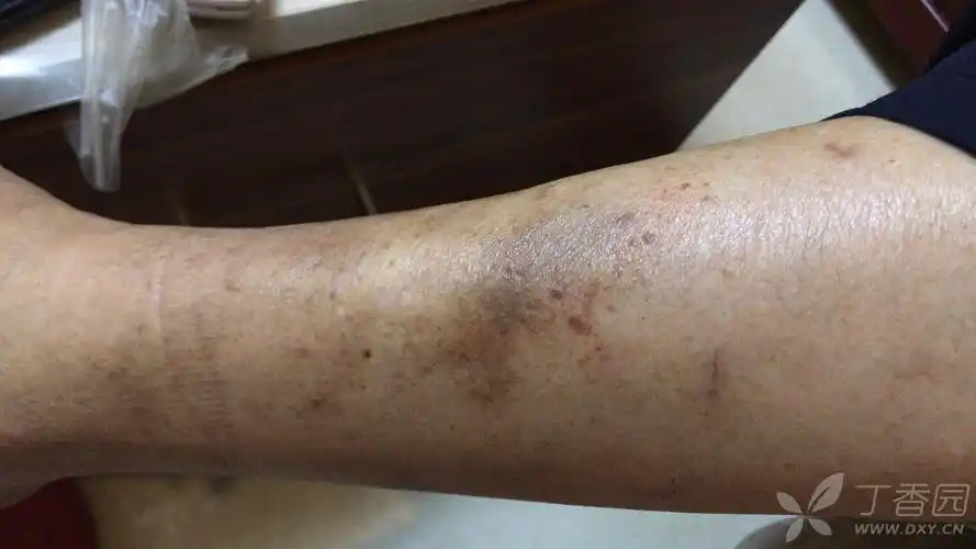 求助:腿部皮肤有黑斑 - 皮肤与性传播疾病讨论版 -丁香园论坛